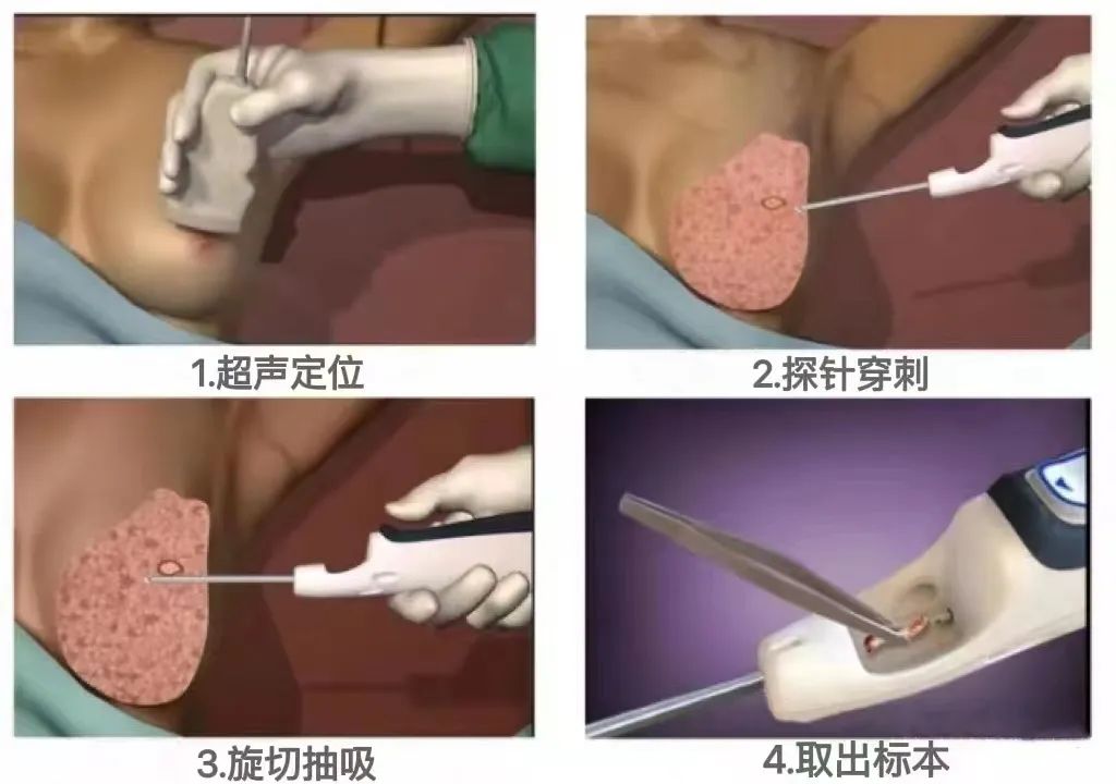 「硬實力」小切口解決大麻煩——乳腺微創(chuàng)旋切術讓美麗不留憾