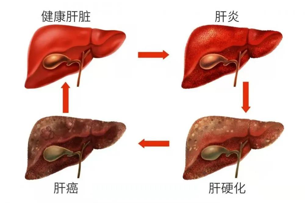 肝癌早期幾乎沒癥狀，如何預防或早期發現？